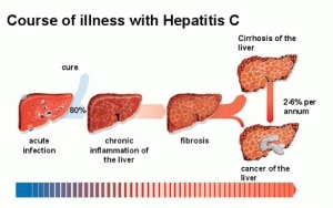Course of Illness with Hepatitis C